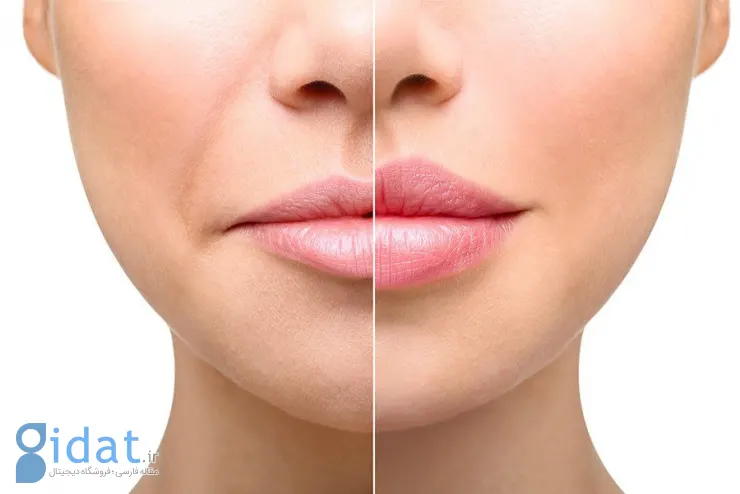 فیلر خط خنده چه مزایا و معایبی دارد؟
